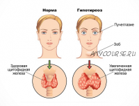 Гипотиреоз - приговор или нет? (Анна Гусова)