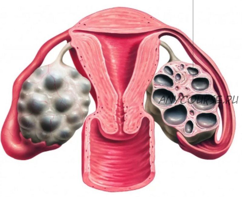 Поликистоз яичников (Гала Гарбузова)