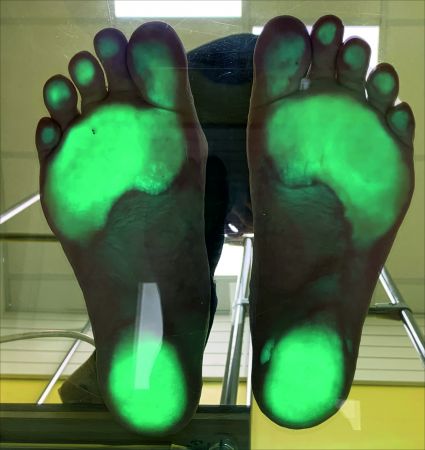 ортопедические стельки при плоскостопии